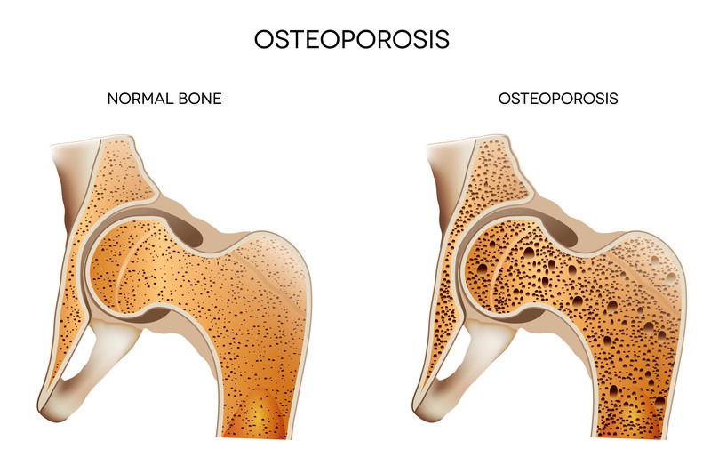 HRT & Bone Loss (Osteoporosis)