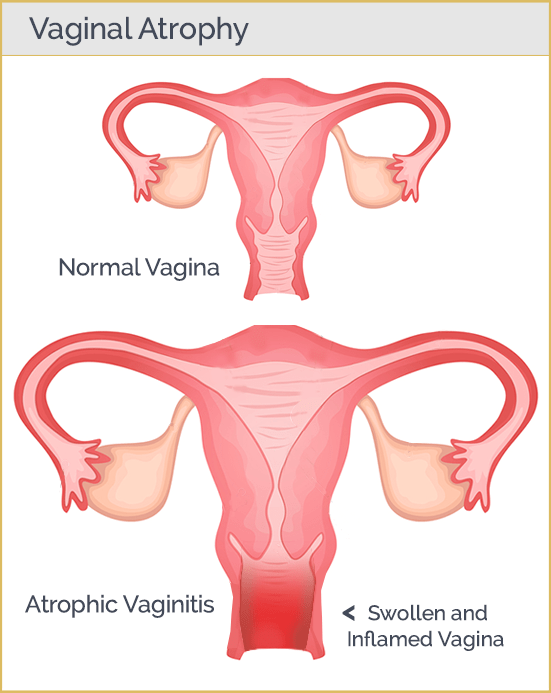 Vaginal Atrophy & Estrogen
